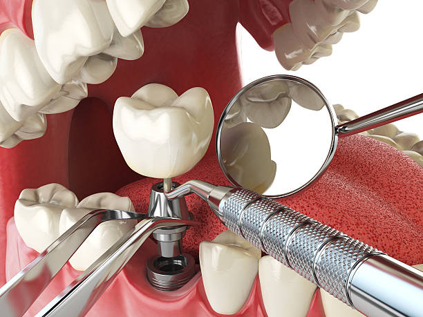Best Emergency Tooth Extraction in Mechanicsville, VA